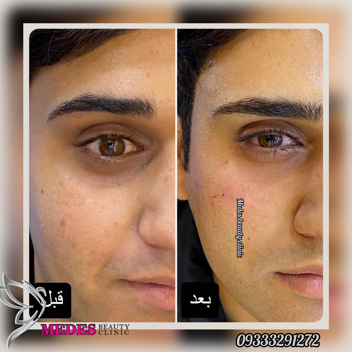 گالری فیلر زیر چشم